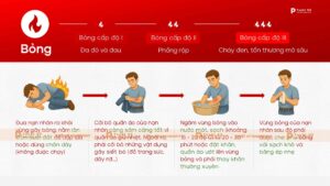 Sơ cứu căn bản khi bỏng