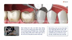 hậu quả của bệnh răng miệng